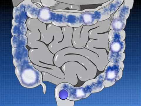 Видео о препарате Салофальк пена для ректального введения 1г №14 (14 штук)